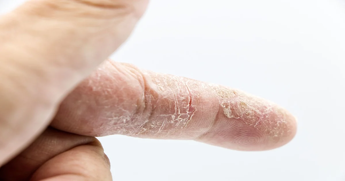 Tropical Skin Conditions: Indian Migrants' Guide